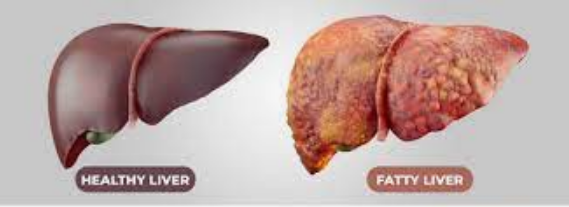 fatty liver management کبد چرب