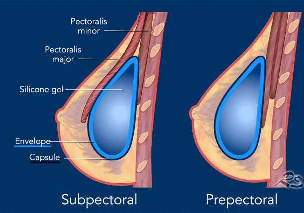 پروتز پستان breast prothesis