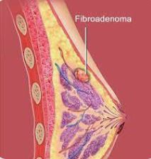 fibroadenoma-فیبروآدنوما