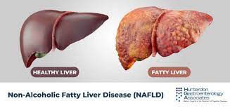کبد چرب -fatty liver