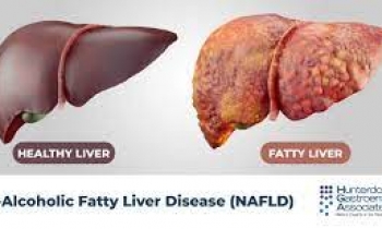 کبد چرب -fatty liver