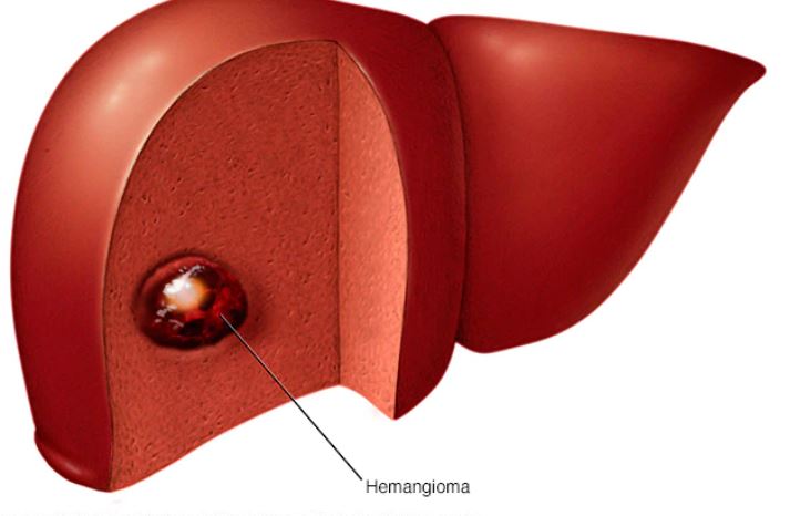 همانژیوما- همانژیوم کبد-hemangioma