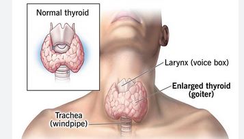 اختلالات خود ایمینی تیروئید _autoimmune thyroid  disease 