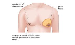 GYNECOMASTIA_ژنیکوماستی _ بزرگی پستان آقایان