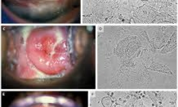 عفون واژن_VAGINOSIS
