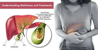 gall stone_سنگ صفرا