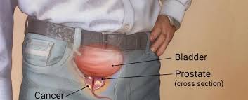پروستات _اندازه طبیعی برای سن